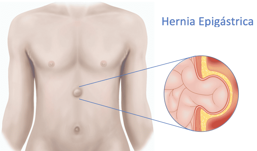 hernia epigastrica