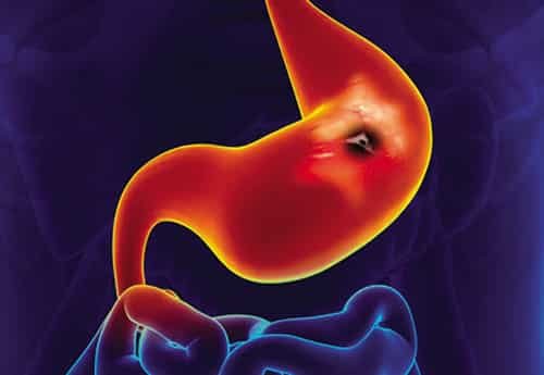 úlceras pépticas