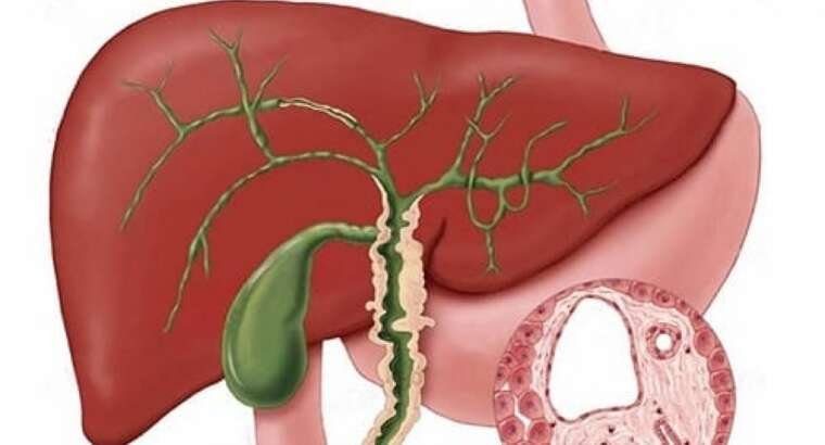 ¿Qué es la colangitis y cómo se trata?