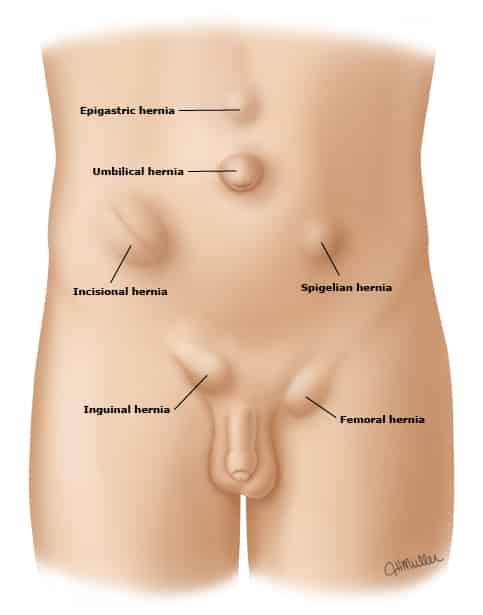 Hernias abdominales