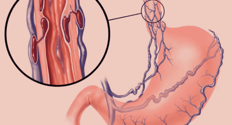 Várices en el Esófago ¿Cuál es su tratamiento?